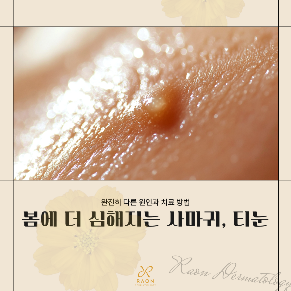왕십리 피부과 사마귀와 티눈 등 CO2 레이저 제거, 냉동치료와의 비교 관련 이미지 1