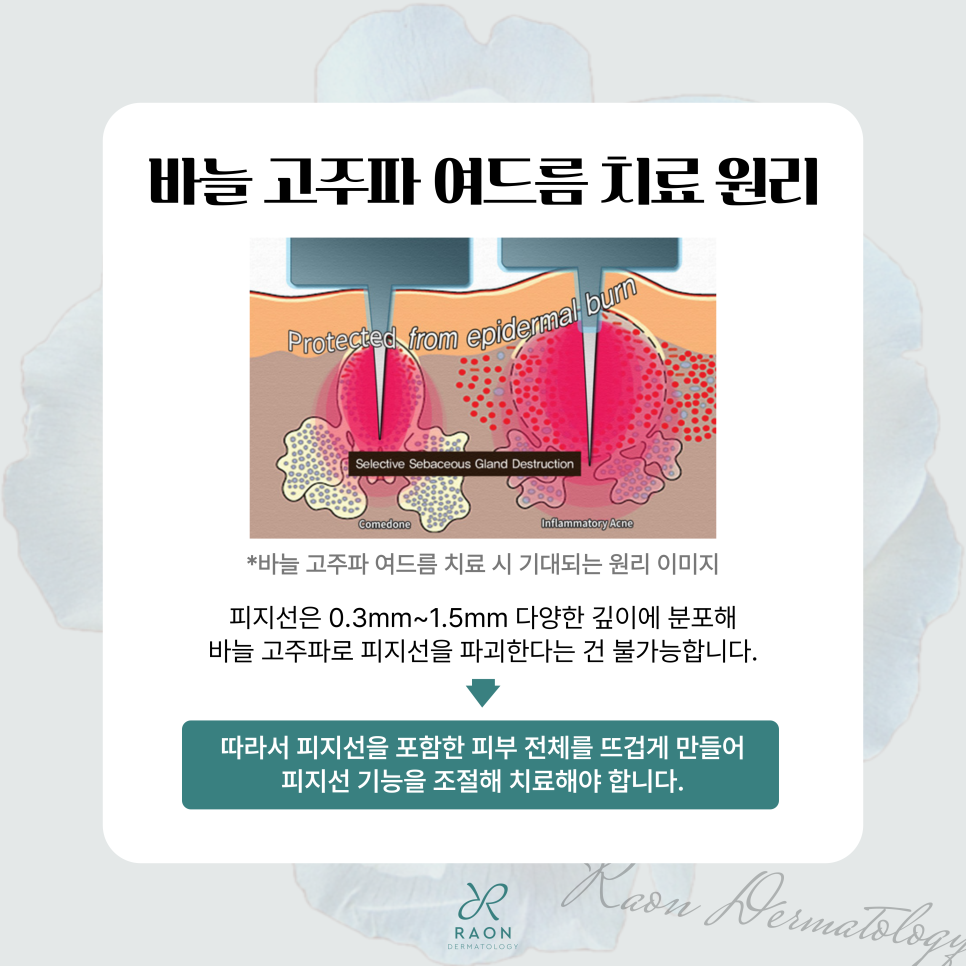 성동구 피부과 바늘 고주파 여드름 치료 이해하기 2편 [백종헌 원장 칼럼] 관련 이미지 3