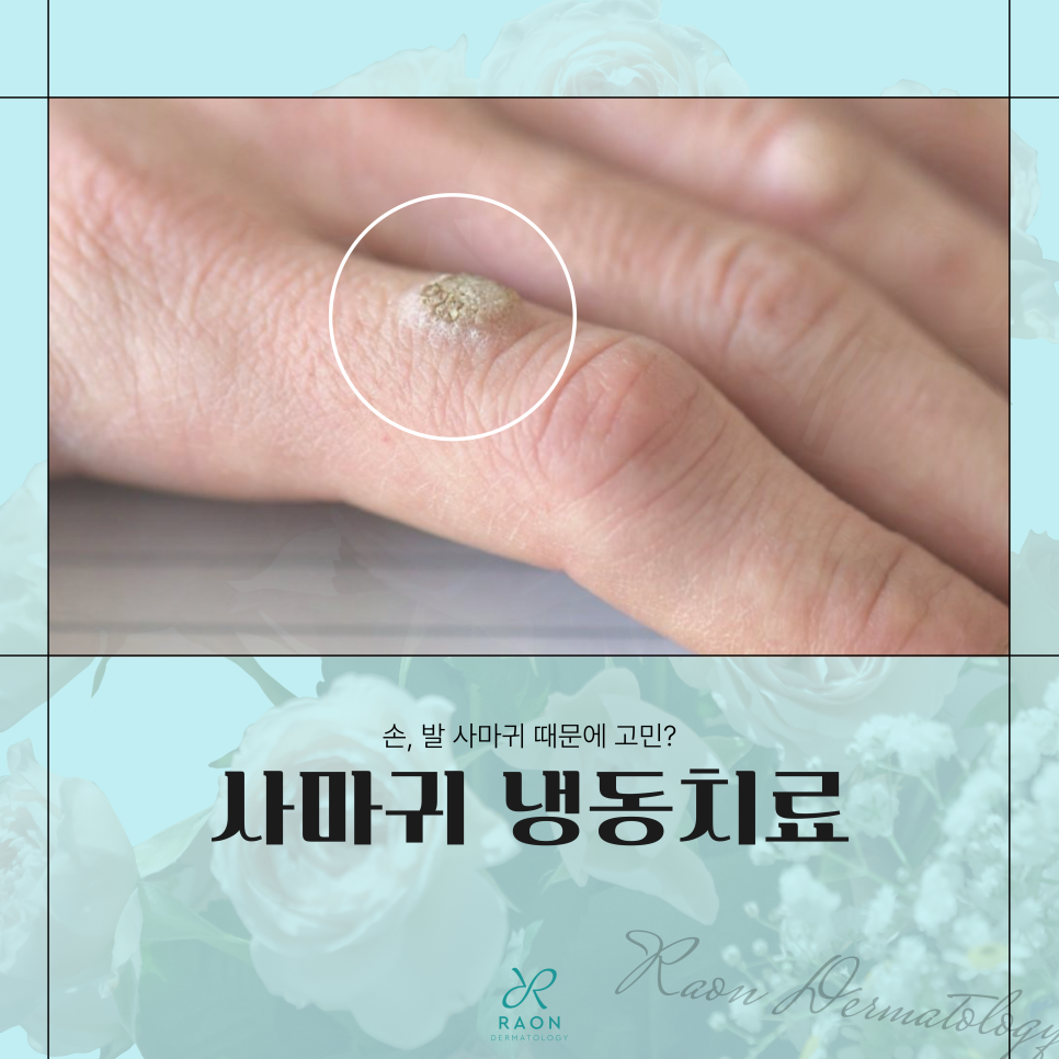 왕십리 피부과 손발 사마귀 냉동치료 및 CO2레이저 적정주기는? 관련 이미지 1
