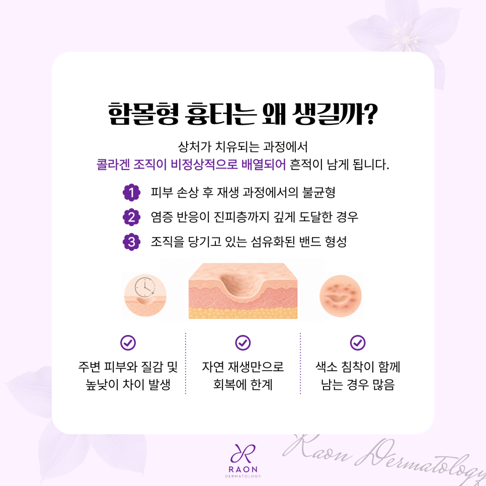 How deeply indented atrophic scars are treated at Wangsimni Dermatology [Laser, Subcision, Regenerative Injection] image 2