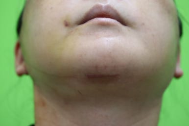 Early Swelling Changes After Facelift (Day 3, 1 Week, 2 Weeks) image 18