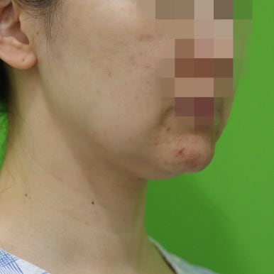 몸은 말랐는데 이중턱살제거가 시급할 때? 관련 이미지 13