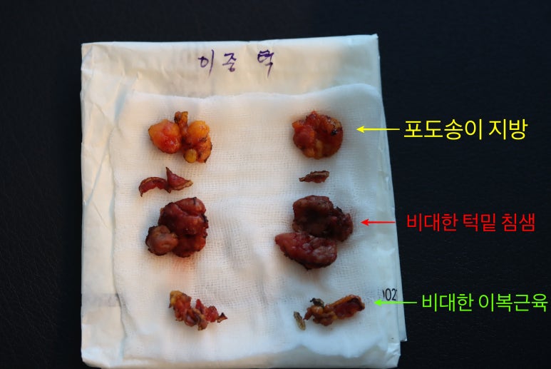 Revision Facelift 3 Months Later, Including Removal of the Existing Scar image 8