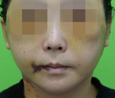 Early Swelling Changes After Facelift (Day 3, 1 Week, 2 Weeks) image 13