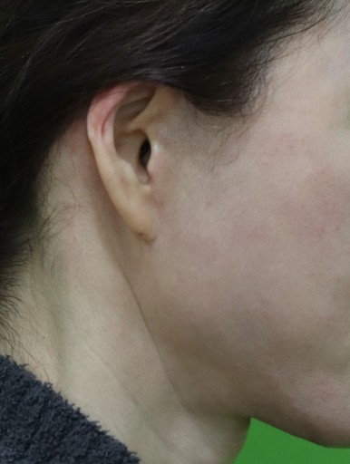 Facelift Scars, the Reason They Look Seamless After 6 Months image 18