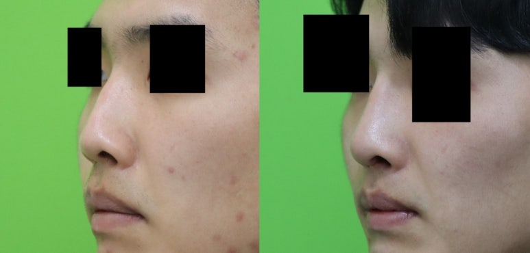 Crooked Nose Surgery: If You Don’t Know This, You’ll Need Revision Surgery Again. image 12