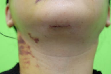 Early Swelling Changes After Facelift (Day 3, 1 Week, 2 Weeks) image 14
