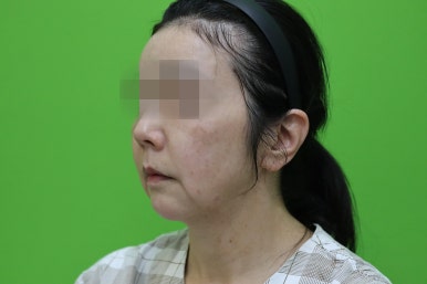 50대 여성 안면거상술 및 이중턱 근육묶기 후기 관련 이미지 2