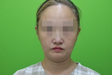 이중턱살제거, 마른 몸에 이중턱만 고민이라면? 관련 이미지 1