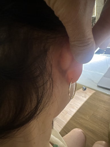 Revision Facelift 3 Months Later, Including Removal of the Existing Scar image 14