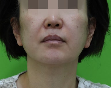 안면거상 재수술, 왜 3년전 수술이 효과가 없었을까? 관련 이미지 4