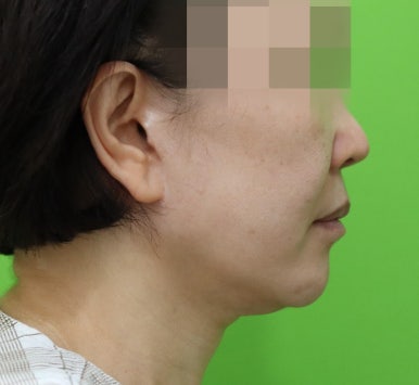 안면거상 재수술, 왜 3년전 수술이 효과가 없었을까? 관련 이미지 25