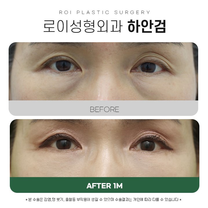 Under-Eye Fat Repositioning vs. Lower Blepharoplasty: Selection Criteria You Should Know image 3
