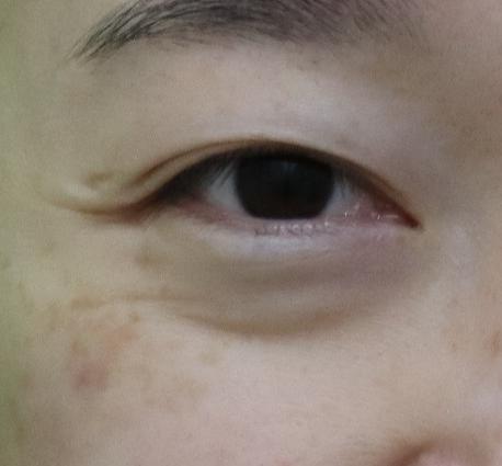 눈밑패임, 이거 모르면 효과 없는 시술에만 돈 씁니다. 관련 이미지 3