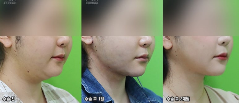 Double Chin Removal: Did You Think Liposuction Alone Would Be Enough? image 4