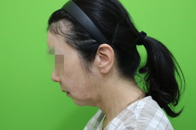 50대 여성 안면거상술 및 이중턱 근육묶기 후기 관련 이미지 4