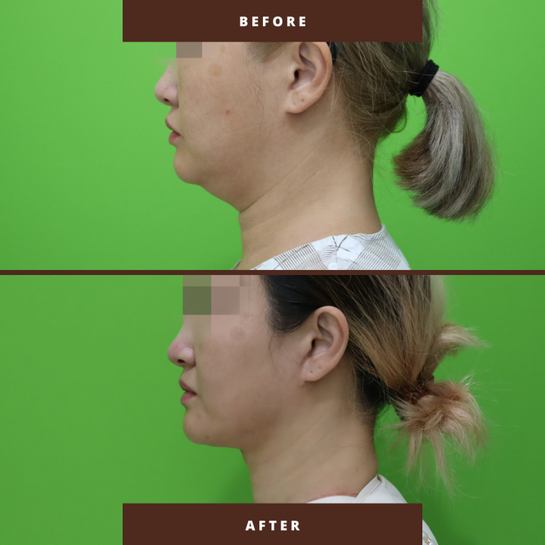 이중턱살제거, 마른 몸에 이중턱만 고민이라면? 관련 이미지 20