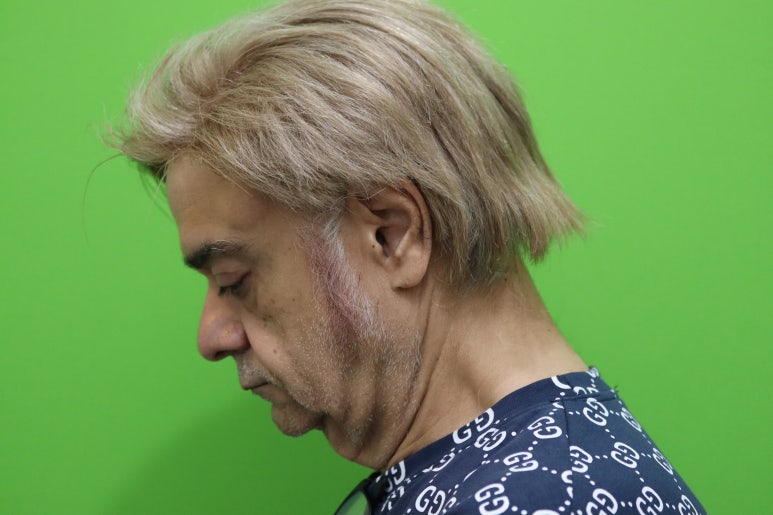 Facelift Review: Why the Neck Lift Technique Matters image 6