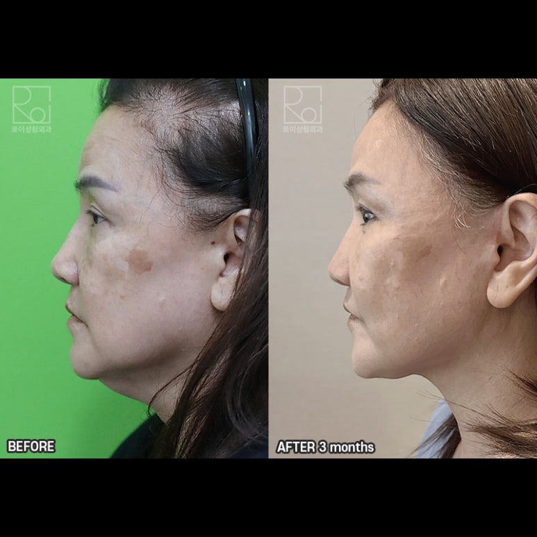 Facelift Review: A Woman in Her Early 60s Looks More Than 10 Years Younger image 8