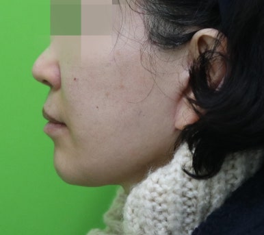 안면거상 재수술, 왜 3년전 수술이 효과가 없었을까? 관련 이미지 17