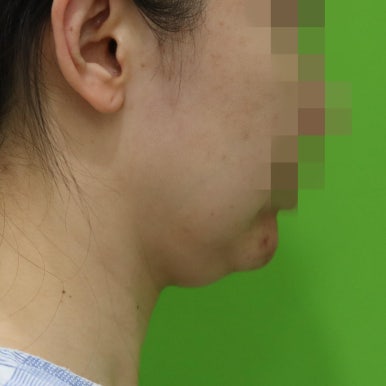 몸은 말랐는데 이중턱살제거가 시급할 때? 관련 이미지 2