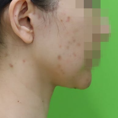 몸은 말랐는데 이중턱살제거가 시급할 때? 관련 이미지 7
