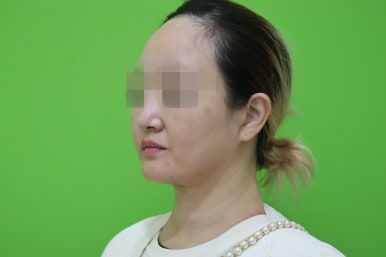 이중턱살제거, 마른 몸에 이중턱만 고민이라면? 관련 이미지 8