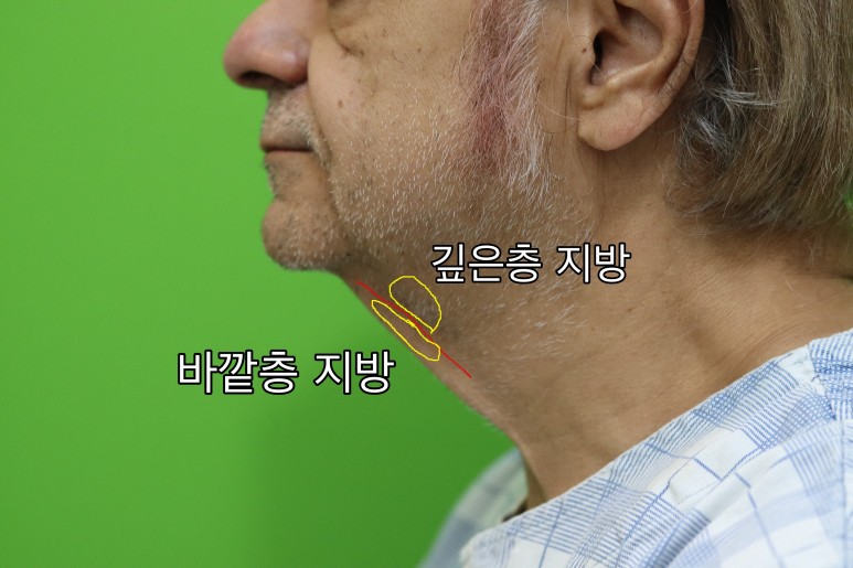 Facelift Review: Why the Neck Lift Technique Matters image 7