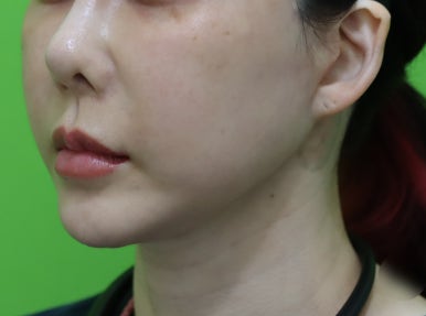 Facelift Results: Can They Be Good Even at a Young Age? image 11