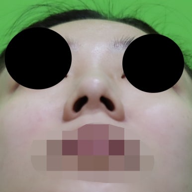 매부리코교정, 코뼈 제거 없이 재배치로 해결 관련 이미지 15