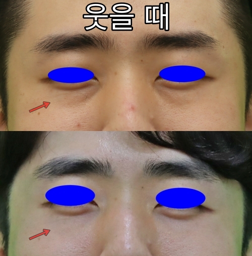 3 Things You Must Know Before Male Under-Eye Fat Repositioning image 6