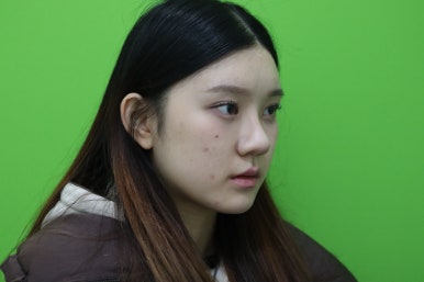 복코성형, 연예인 지망생의 리얼 후기 관련 이미지 13