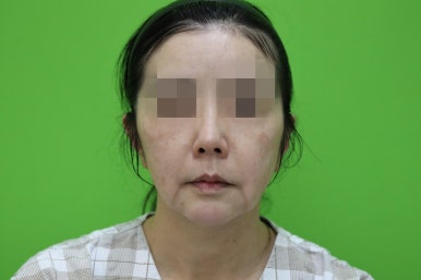 50대 여성 안면거상술 및 이중턱 근육묶기 후기 관련 이미지 1