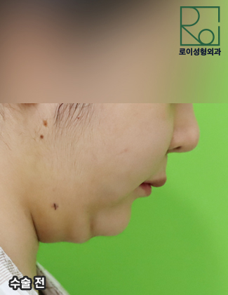 Double Chin Removal: Did You Think Liposuction Alone Would Be Enough? image 2