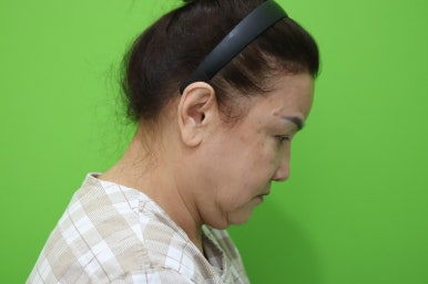 Facelift Review: A Woman in Her Early 60s Looks More Than 10 Years Younger image 5