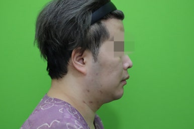 Double Chin Muscle Tying Swelling, Day 1 Appearance image 15