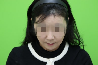 50대 여성 안면거상술 및 이중턱 근육묶기 후기 관련 이미지 8