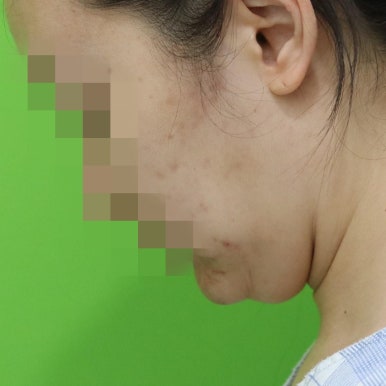 몸은 말랐는데 이중턱살제거가 시급할 때? 관련 이미지 5