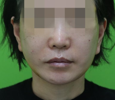 안면거상 재수술, 왜 3년전 수술이 효과가 없었을까? 관련 이미지 7