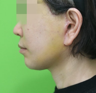안면거상 재수술, 왜 3년전 수술이 효과가 없었을까? 관련 이미지 9