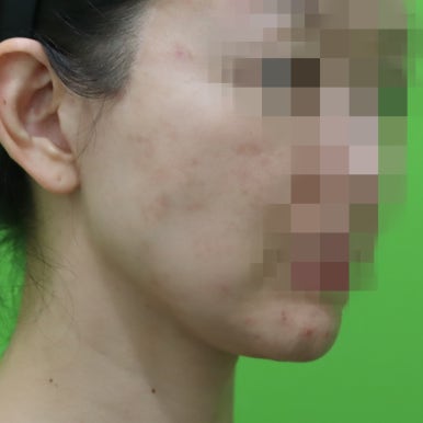 몸은 말랐는데 이중턱살제거가 시급할 때? 관련 이미지 14