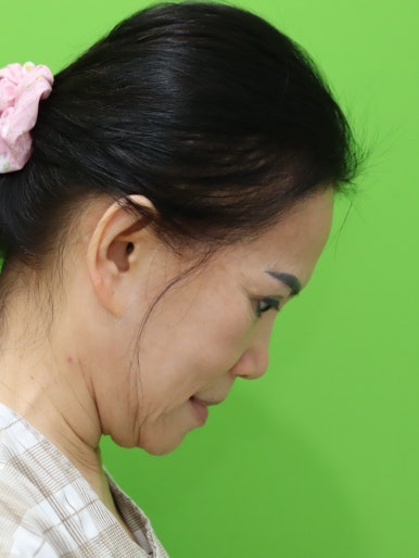 Revision Facelift 3 Months Later, Including Removal of the Existing Scar image 11