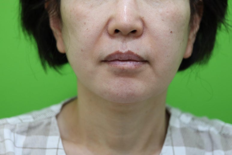 안면거상 재수술, 왜 3년전 수술이 효과가 없었을까? 관련 이미지 1