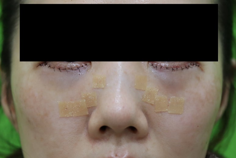 Blepharoplasty Day 1 and Day 7 Swelling and Scar Review image 2