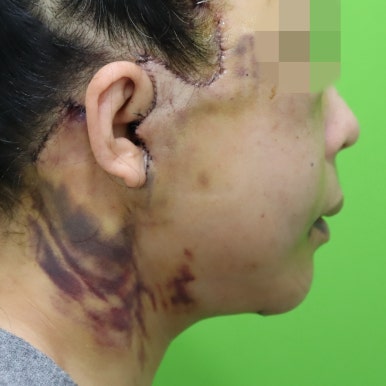 Early Swelling Changes After Facelift (Day 3, 1 Week, 2 Weeks) image 7