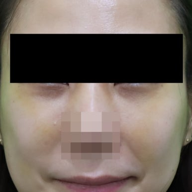 웃을때 눈밑지방, 정말 근육이라 개선이 안될까? 관련 이미지 4