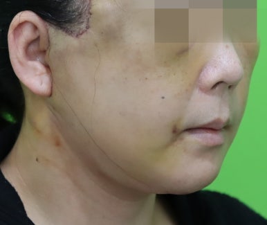 Early Swelling Changes After Facelift (Day 3, 1 Week, 2 Weeks) image 27