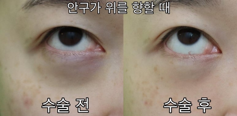 눈밑패임, 이거 모르면 효과 없는 시술에만 돈 씁니다. 관련 이미지 7