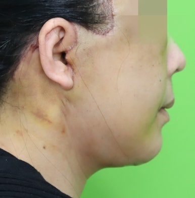 Early Swelling Changes After Facelift (Day 3, 1 Week, 2 Weeks) image 19