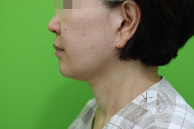 안면거상 재수술, 왜 3년전 수술이 효과가 없었을까? 관련 이미지 5